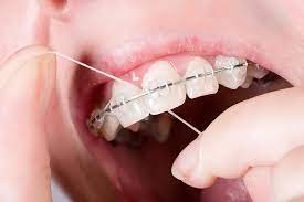 Simply place a piece of floss in the opening of the threader and use the tip to go between your teeth and braces. Can You Floss If You Have Braces Yes You Can And Here S How Amazing Smiles Dentist Clinics