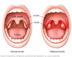 Adult Tonsillectomy Glacier Ear Nose Throat Ent Clinic