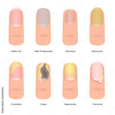 cartoon color nail diseases icon set