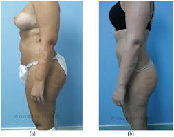 laser assisted liposuction in face and