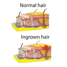 ingrown hair vector art stock images