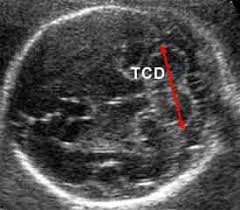 Appendix Iii Fetal Biometry At 14 40 Weeks Gestation