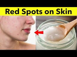 how to remove red spots on face