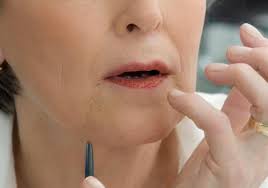 treatment of upper lip lines