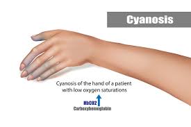 cyanosis during pregnancy the pulse