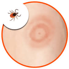 tick bites prevention identification