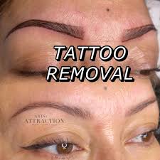 non laser tattoo removal in st