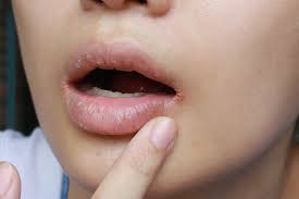 treating dry chapped lips thirdage