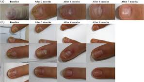 a nail dystrophy is almost resolved