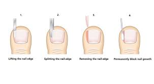 partial nail avulsion ingrown toenail