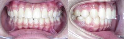 How can you fix an underbite without surgery? Non Surgical Non Extraction Treatment Oakridge Orthodontics Vancouver Bc