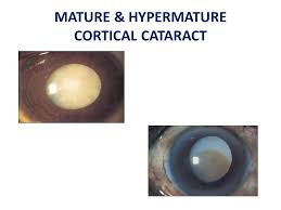 Age Related Senile Cataract Dr Manoj Vasudevan Associate