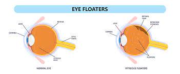 eye floaters in diffe age groups