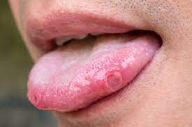 canker sore on tongue symptoms causes