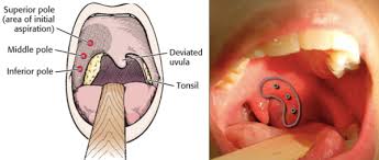 peritonsillar abscess