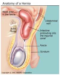 What Is A Hernia Inguinal Incisional Umbilical Hiatal