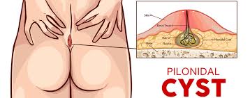 pilonidal cyst rs surgical symptoms