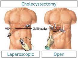 gallbladder removal surgery recovery