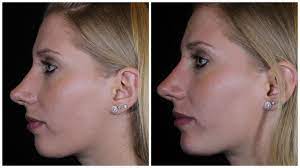 reshaping your nose without surgery