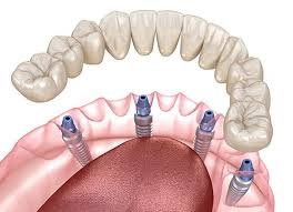 implanturi dentare rapide
