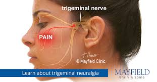 pain trigeminal neuralgia