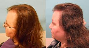 female hair loss treated with