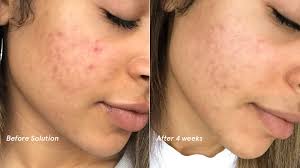 glossier acne solution how alpha