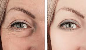puffy under eyes after eyelid fillers