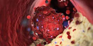 Хемостаза је процес која одржава интегритет и висок притисак у крвотоку након оштећења. Tromb Kako Da Simptome Prepoznate Na Vreme Dr Nestorov