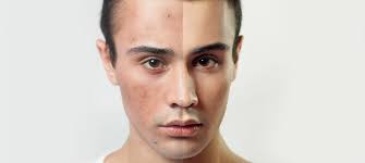 acne what it is and how to get rid of