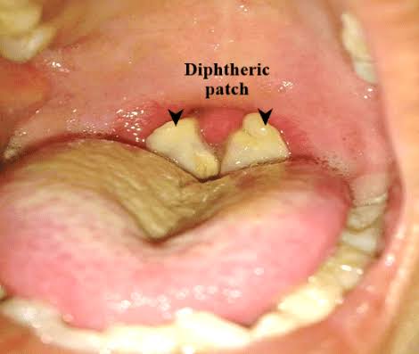 Everything About Diphtheria Infection: Symptoms, Causes, Diagnosis & Treatment