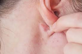 lump behind ear top 6 causes when
