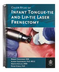 infant laser frenectomies