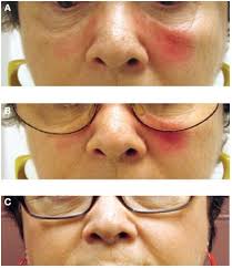 malar rash caused by metal allergy in a