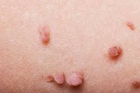 Ingrown hairs can look like raised, red, itchy spots on the skin. Rashes Bumps And Lumps Below The Belt