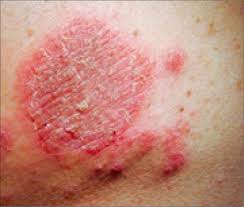 eczema and the older person