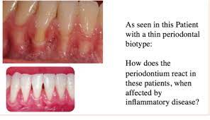 ch 19 clinical periodontal sment