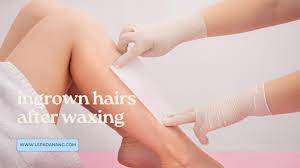how to prevent ingrown hairs after