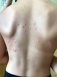 Psoriasis usually appears in early adulthood. Psoriasis Wikipedia