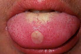 cold sores vs canker sores vs chancres