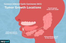 adenoid cystic carcinoma symptoms and