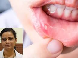 ayurveda remes to cure mouth ulcers