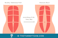 Diastasis Recti - The Tummy Team