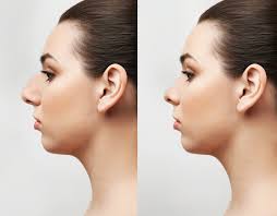 rhinoplasty cosmetic nose surgery in