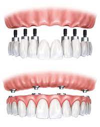 full mouth dental implants cost in