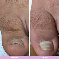 painless treatment for ingrown toenails