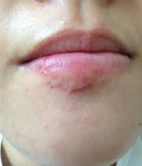 advice on lip scar from dog bite 4