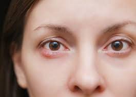 what causes styes and how to avoid them