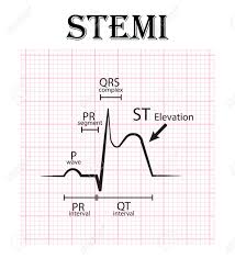 Ecg Of St Elevation Myocardial Infarction Stemi And Detail