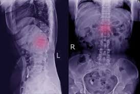 Fractures of lumbar vertebrae, therefore, occur in the setting of either severe trauma or pathologic weakening of the bone. 3 Types Of Spinal Fractures Dr Nael Shanti